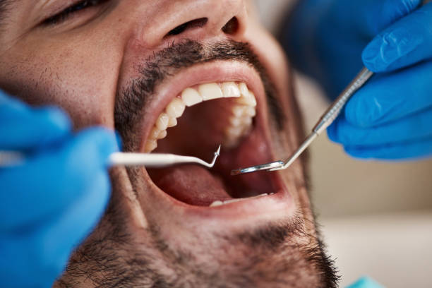 Best Emergency Broken Tooth Repair in Poulsbo, WA